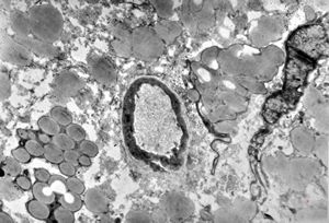 M,35y. | duodenum … lipid malabsorption - susp. hypo-beta-lipoproteinemia